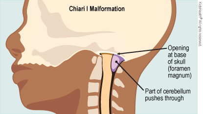 Diagram of Chiari I malformation shows the skull with opening at the base of the skull (the foramen magnum) and part of the cerebellum pushing through this opening.