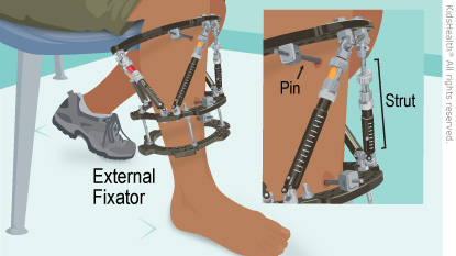 Illustration: external fixator