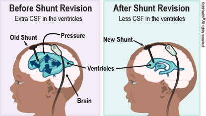 First diagram is before shunt with extra CSF in the ventricles and shows brain, ventricles, and increased pressure in the ventricles. Second diagram is after shunt with less CSF in the ventricles and shows the shunt in the ventricles.