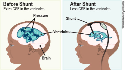 Before the shunt there is extra CSF in the ventricles which puts pressure on the brain. After the shunt there is less CSF in the ventricles and the pressure on the brain is relieved.