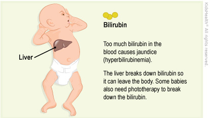 Illustration: hyperbilirubinemia