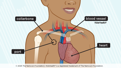 Child with Implanted port, heart, blood vessel and clavicle