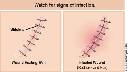 Diagram showing a wound with stitches healing well and an infected wound with redness and pus around the stitches. Watch for signs of infection.
