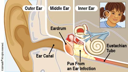 Pus from an ear infection collects in the middle ear, near the eardrum.