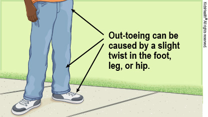 Out-toeing can be caused by a slight twist in the foot, leg, or hip.