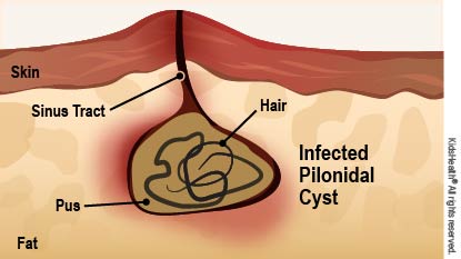 Cross section showing infected pus- and hair-filled pilonidal cyst under the skin, with a sinus tract.