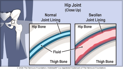 A close up of a normal hip joint shows fluid between the hip bone and thigh bone, whereas a swollen joint lining has more fluid and inflammation.