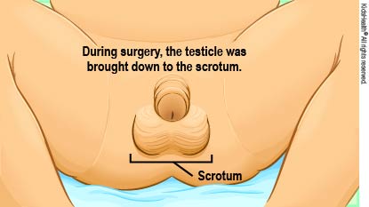 During surgery, the undescended testicle is brought down to the scrotum.