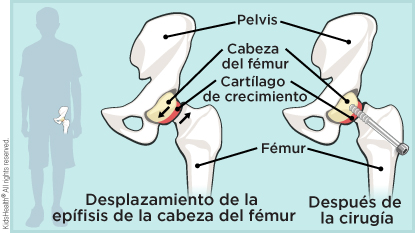 Pelvis, cabeza del fémur, cartílago de crecimiento, fémur en cadera normal y desplazamiento de la epífisis de la cabeza del fémur. El desplazamiento reparado tiene un tornillo a través del fémur en la cabeza del fémur.