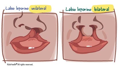 Ilustraci?n que muestra un labio leporino unilateral y un labio leporino bilateral, de la manera que se describe en el art?culo.