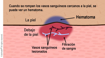 Cuando se rompen los vasos sanguíneos cercanos a la piel, se puede ver un hematoma.