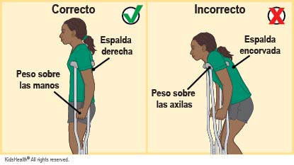 La forma correcta de usar muletas es mantener la espalda derecha y poner todo el peso sobre las manos. La forma incorrecta es mantener la espalda encorvada y poner todo el peso sobre las axilas.
