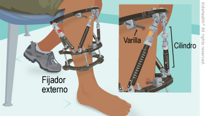 Illustration: External Fixator
