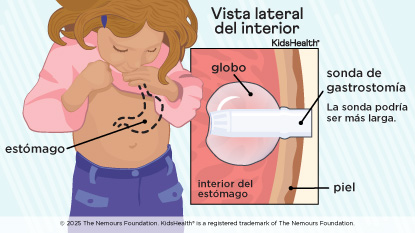 Vista interior del estómago de un niño con sonda de gastrostomía