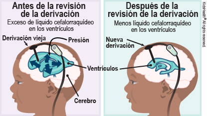 La primera ilustración muestra el cerebro antes de la derivación con un exceso de líquido cefalorraquídeo en los ventrículos. También muestra el cerebro, los ventrículos y el aumento de presión en los ventrículos. La segunda ilustración muestra el cerebro después de la derivación con menos líquido cefalorraquídeo en los ventrículos. También muestra la derivación en los ventrículos.