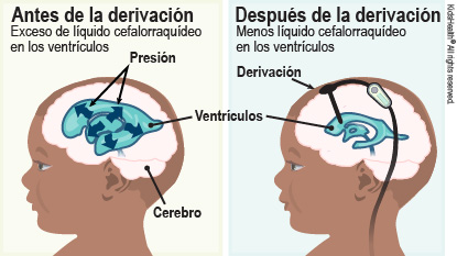 Antes de la derivación, hay un exceso de líquido cefalorraquídeo en los ventrículos que ejerce presión sobre el cerebro. Después de la derivación, hay menos líquido cefalorraquídeo en los ventrículos y esto reduce la presión en el cerebro.