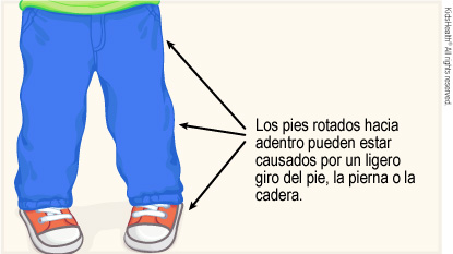 Se muestra a un niño pequeño con los pies apuntando hacia adentro y flechas que apuntan a posibles lugares causantes de la afección: ligero giro en el pie, la pierna o la cadera.
