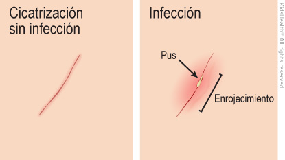 Illustration: healthy healing compared to infection showing pus and redness