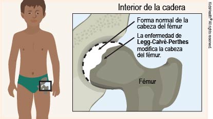Ilustración de la cabeza del fémur con su forma normal y el cambio que la enfermedad de Legg-Calvé-Perthes produce en la cabeza del fémur, de la manera que se describe en el artículo.