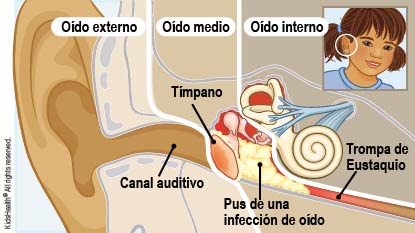 El pus de una infección de oído se acumula en el oído medio, cerca del tímpano.