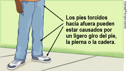Los pies torcidos hacia afuera pueden estar causados por un ligero giro del pie, la pierna o la cadera.