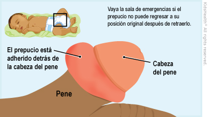 Vaya la sala de emergencias si el prepucio no puede regresar a su posicion original despues de retraerlo.