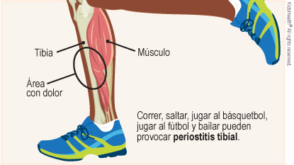 El diagrama muestra la tibia, el m?sculo y el ?rea con dolor en la espinilla. Correr, saltar, jugar al b?squetbol, jugar al f?tbol y bailar pueden provocar periostitis tibial.